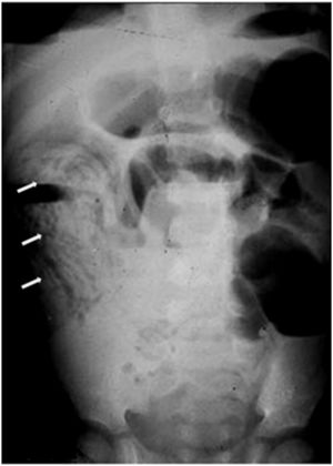 Abdominal plain abdominal X-ray showing intestinal obstruction by Ascaris (arrows).
