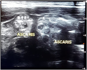Abdominal ultrasound showing A. lumbricoides in the intestinal lumen.