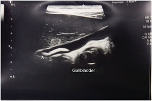 Biliary tract ultrasound. Note Ascaris in the gallbladder (A).