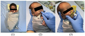 Series of Interventions Given in the Experimental Group. Step 1: Physiological flexion swaddling. Step 2 & 3: Oromotor interventions: Oral stimulation, three-finger jaw control, and non-nutritive sucking stimulation using a premiee pacifier.