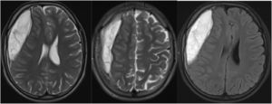 Brain imaging of the patient in the first group. Axial T2A/FLAIR sections show a subacute, chronic epidural, subdural hematoma in the right frontoparietal region, causing a shift in the midline.