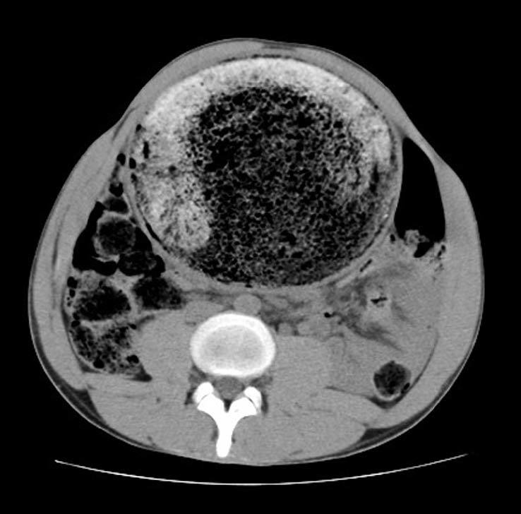 Enfermedad De Hirschsprung Del Adulto Medicina Clínica 9339