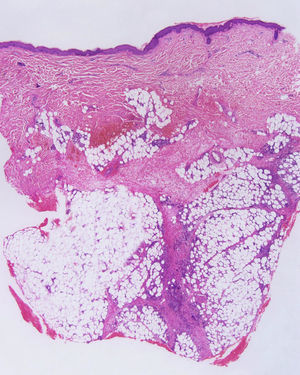 Paniculitis de predominio septal. Se observa afectación paraseptal, pero el centro del lobulillo tiene un aspecto normal.
