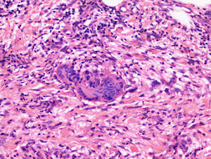 Paniculitis septal en fase avanzada. En el infiltrado hay histiocitos y granulomas con células gigantes.