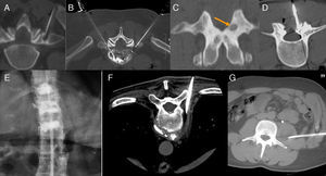 A) Rizolisis. Colocación de la aguja en la base de la apófisis transversa donde pasa el ramo dorsal del nervio espinal. B) Ablación termal con radiofrecuencia del disco L5-S1. C) Reconstrucción multiplanar coronal de osteoma osteoide del arco vertebral (flecha). D) Imagen axial durante la ablación tumoral con radiofrecuencia. E) Vertebroplastia en un paciente con espondilitis anquilosante. F) Drenaje de absceso prevertebral tuberculoso. G) Drenaje de absceso brucelósico en compartimento del psoas.