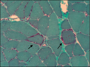 Biopsia muscular de la paciente 1 (tinción modificada de tricrómico de Gomori para tejido congelado). Se observan varias fibras típicas «rojas rasgadas» (flechas negras), así como núcleos en el interior de algunas fibras y variabilidad en el tamaño de estas. Todo ello es compatible con miopatía mitocondrial.