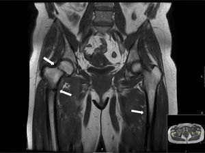 Resonancia magnética nuclear (T1) que muestra la existencia de fractura al nivel del cuello femoral derecho y del tercio proximal de la diáfisis de ambos fémures.