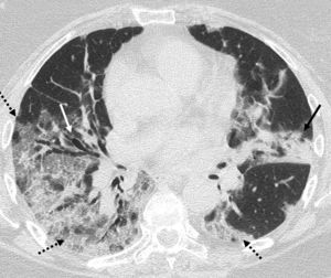 Imagen de TCT. Paciente de 60 años con resultado positivo de PCR para SARS-CoV-2. En el estudio de TCT se observan opacidades en vidrio deslustrado periféricas en ambos hemitórax (flechas discontinuas), un foco de consolidación en língula (flecha negra) y bronquiectasias (flecha blanca).