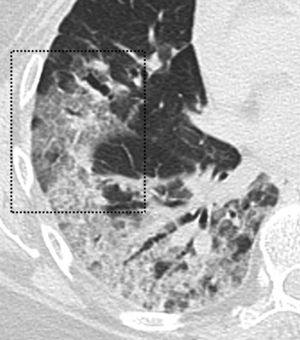 Imagen de TCT. Paciente de 60 años con resultado positivo de PCR para SARS-CoV-2. En el estudio de TCT se observa el patrón en empedrado (recuadro negro), como resultado de la superposición de opacidades en vidrio deslustrado asociadas a engrosamiento de los septos inter e intralobulillares.