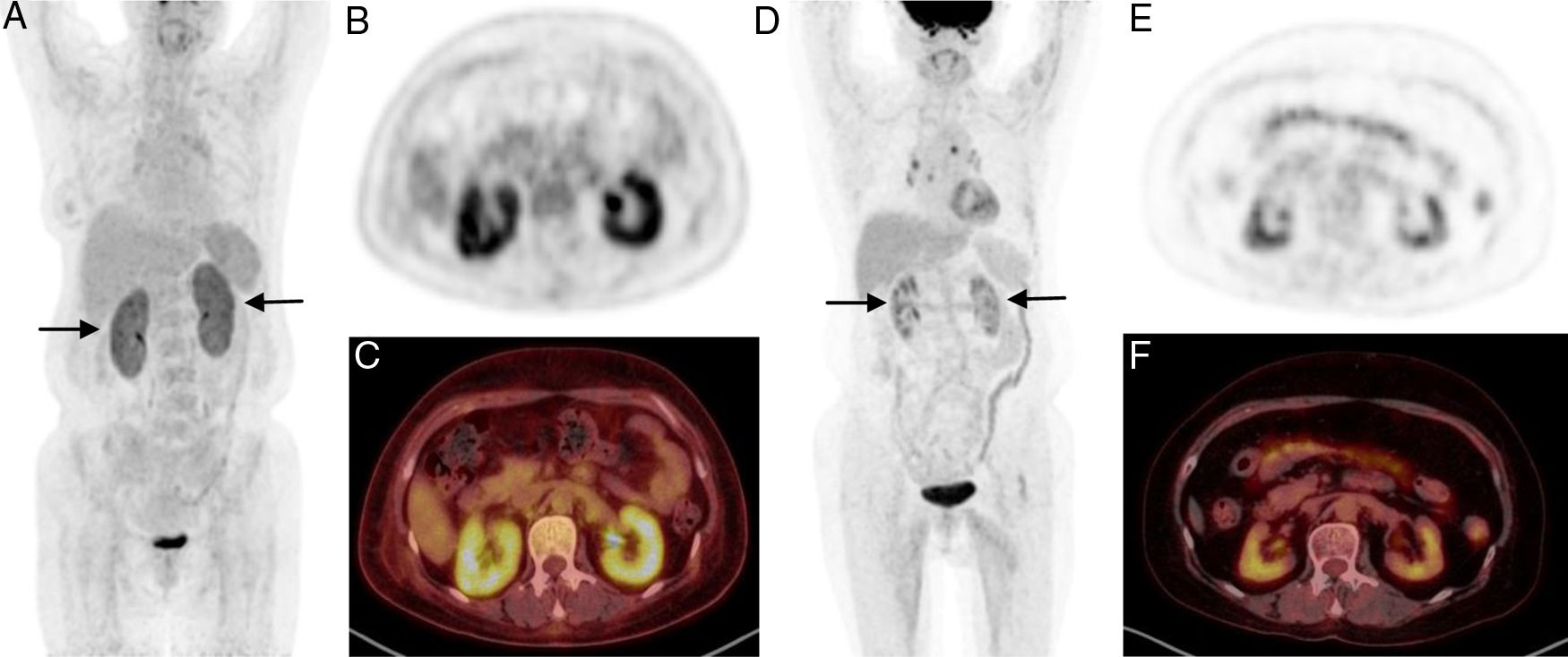 Usefulness of PET/CT in ANCA associated renal vasculitis | Medicina Clínica