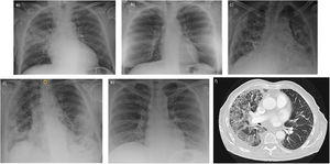 Chest X-ray in our series show bilateral infiltrates with an interstitial pattern in patients 2, 3 and 5 (image b, c, e) and a more consolidative pattern in patient 4 (image d). In patient 1, the appearance was that of a lobar consolidative pneumonia (image a). Subsequent CT scan of this patient (image f) also revealed ground-glass opacities suggesting organizing pneumonia.