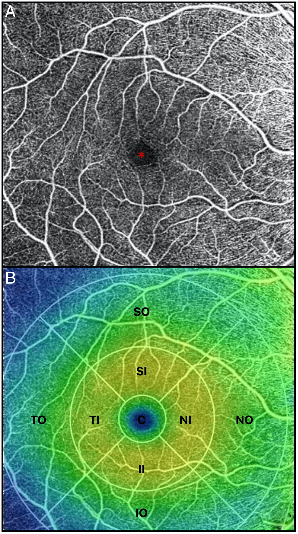 Reduced retinal vessel density in COVID-19 patients and elevated D ...