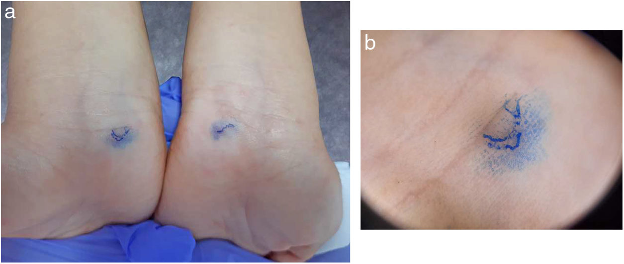 Scabies Testing Prueba de la tinta en la escabiosis | Medicina Clínica