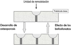 Desarrollo de osteoporosis: aumento de las unidades de remodelación y, por tanto, de los espacios de pérdida ósea reversible (representados por las semilunas) y de los concentradores de tensión (representados por las zonas rayadas). Efecto de los bisfosfonatos: fenómenos opuestos. No se representa el comportamiento del balance óseo.