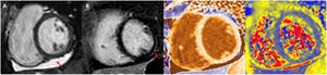 Ejemplo de resonancia magnética cardiaca en paciente con miocarditis por COVID-19. Se objetiva derrame pericárdico (A, flecha) en las secuencias de CINE SSFP, realce tardío subepicárdico en segmento inferolateral medio (B, flecha) y aumento de los valores de T1 en mapping nativo (C) y T2 en mapping (D).