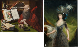 (A) “SaintHieronymus”. Marinus Van Reymerswaele, XVI century Aracnodactyly (arrow) and Seborrheic Keratosis (arrow). (B) “María Luisa de Parma, queen ofSpain”. Francisco de Goya, Replica. The velvet patch on her temple (arrow) probably was dabbed with morphine to alleviate migraines; a forerunner of the fentanyl patches we use today.