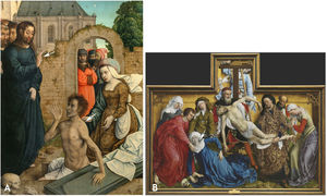 (A) “The raising ofLazarus”. Juan de Flandes, 1514–1519. Lazarus is portrayed with a dislocated left shoulder that could be a result of a seizure (arrow). There is also an example of a Hand of Benediction (Christ), related to a nerve palsy or Dupytren's disease (dotted arrow). (B) “The Descen from theCross”. Rogier van der Weyden, 1443. In the figure with the blue dress a diffuse goiter can be seen (arrow). She also is the representation of an emotional syncope.