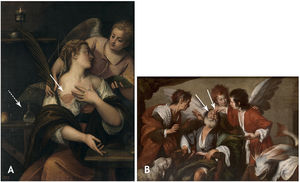 (A) “Saint Agatha”. Veronese, 1590–93. A sharp cut of mastectomy can be observed (arrow) with therapeutic intention because of the help of an Archangel. On the left is a bottle with healing oil (dotted arrow). (B) “Tobias Healing hisFather”. Bernardo Strozzi, 1640–44. Alcali caustication in both eyes (arrows).