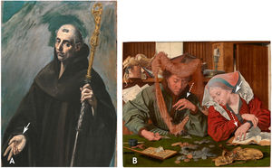 (A) Saint Benedict. El Greco, 1577–1579. Ulnar Nerve Palsy (arrow). (B) “The Moneychanger and his wife”. Marinus van Reymerswaele, 1539. Left cervical enlarged lymphnodes (arrow) and arachnodactyly (dotted arrows).