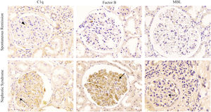 Typical renal histopathological of complement pathway activation in patients with PLA2R-associated MN. Immunohistochemical staining for C1q, factor B, and mannose-binding lectin (MBL) in the glomeruli to detect the complement pathway in patients with PLA2R-associated MN. (a) Immunohistochemical staining for C1q, factor B, and MBL in patients with spontaneous remission. The expression of C1q was slightly positive in only one patient (C1q, arrowheads). (b) Immunohistochemical staining for C1q, factor B, and MBL in patients with nephrotic syndrome (arrow).