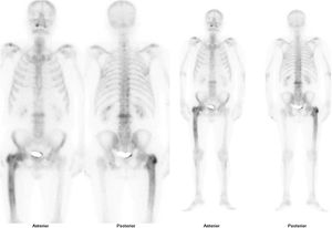 Gammagrafía ósea con tecnecio99. Aumento de captación en región superior del fémur izquierdo.