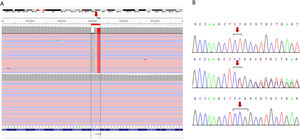 Resultados de los estudios genéticos realizados a la familia 1. A) Identificación de la alteración en homocigosis en el exón 1 del gen CYP27B1 mediante secuenciación masiva (NGS). Los archivos obtenidos del alineamiento de las lecturas NGS paired-end (rosa, sentido; azul, antisentido) está cargado en el visor del genoma interactivo, IGV para su visualización. La secuencia del gen está en la orientación inversa en el cromosoma (hebra –1). Se indica la posición de la mutación mediante una flecha roja. La raya negra representa deleción, posteriormente se muestra el cambio por una timina (rojo) en homocigosis. El panel superior corresponde a la persona índice, mientras que el inferior a una persona control. B) Confirmación mediante secuenciación Sanger de la presencia de la variante c.103_104delinsA (nombrada en la hebra+1, según recomendaciones internacionales). El panel superior corresponde a la secuencia de la paciente índice, el intermedio a su padre y el inferior a una muestra control. Los resultados de la hermana y de la madre son idénticos a los mostrados en el panel superior y medio, respectivamente (datos no mostrados). Los nucleótidos alterados se muestran entre corchetes negros, la posición de la mutación se señala con una flecha roja.