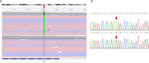 Resultados de los estudios de secuenciación realizados a la familia 2. A) Visualización en el visor IGV de los resultados de la secuenciación NGS en los que aparece la sustitución de guanina por adenina (flecha roja), en homocigosis en el gen CYP27B1 en la paciente índice (panel superior), respecto a un control (panel inferior). La secuencia del gen está en la orientación inversa en el cromosoma. B) Validación, mediante secuenciación Sanger, de la presencia de la variante patogénica c.1226C>T (nombrada en la hebra+1, según recomendaciones internacionales). El panel superior corresponde a la secuencia del paciente índice y el inferior a una muestra control. La flecha indica la posición del nucleótido sustituido.