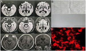 Magnetic resonance imaging (MRI) (A), electroencephalography (EEG) (B), anti-LGI1 antibody protein expression in cerebrospinal fluid (CSF) (C), of case 2.