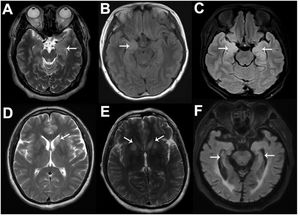Typical magnetic resonance imaging (MRI) images of six anti-LGI1-related encephalitis patients. As shown by the white arrows, increased signals on MRI fluid-attenuated inversion recovery or T2 sequences can be seen in the left MTL (A), right MTL (B), bilateral MTL (C), left BA (D), and bilateral BA (E), and hippocampal atrophy can be seen (F).