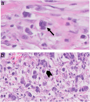 Expresión del TB en H&E: a) El TB se define como células individuales y grupos aislados de hasta 4 células, en el frente invasor del tumor (flecha negra). b) Ejemplo de TB de alto grado (punta de flecha).