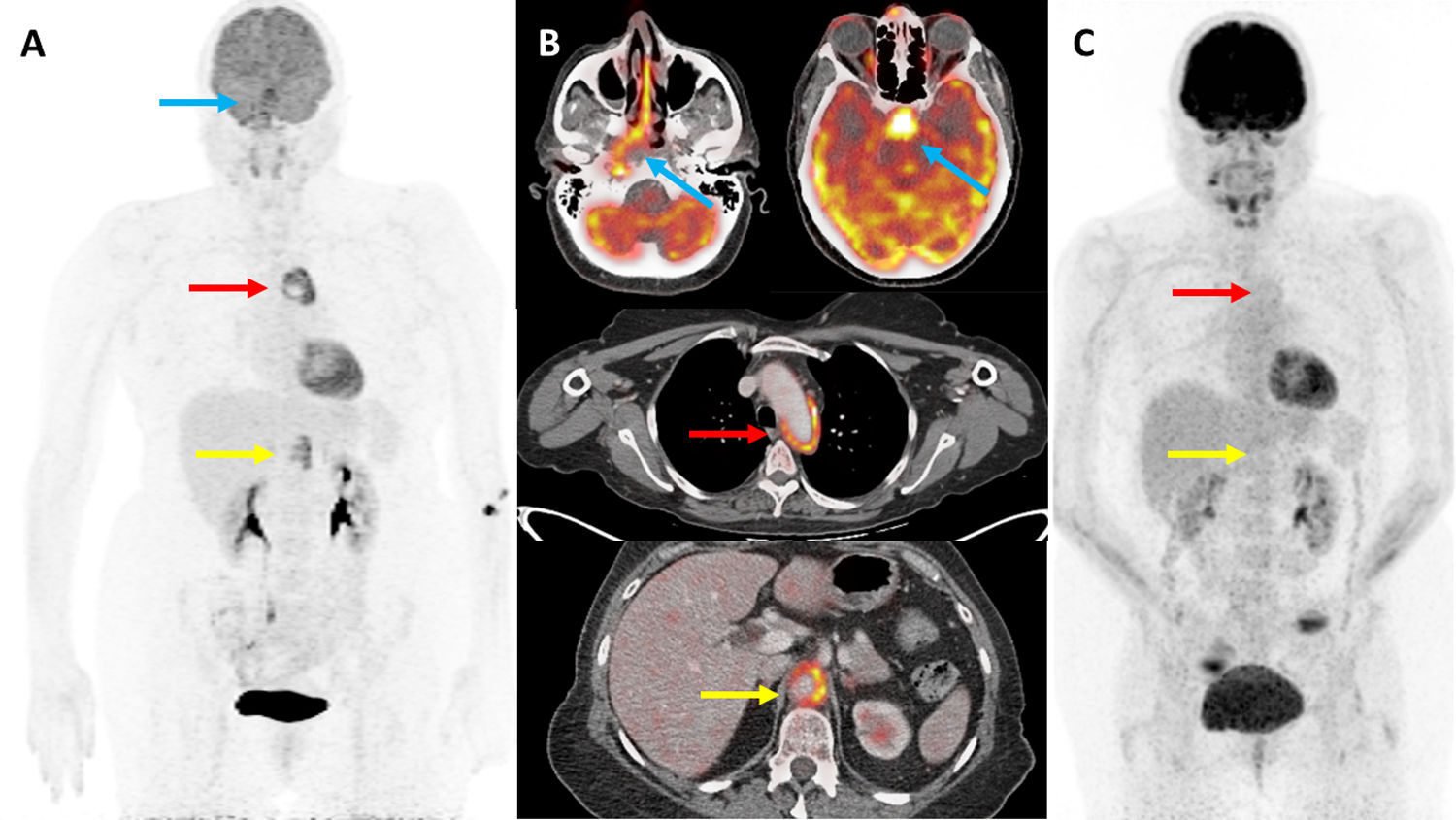 Utility of 18F-FDG PET/CT in the diagnosis and follow-up of a patient ...