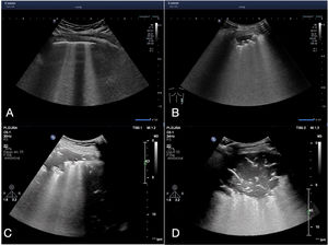 Point-of-care ultrasound in pulmonary and pleural infections | Medicina ...