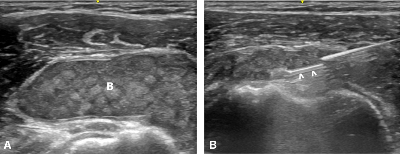 Ultrasound in the study of soft tissue infections | Medicina Clínica