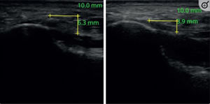 Aspecto longitudinal ecográfico del espesor de la fascia plantar. Lado sintomático (izquierdo) y lado asintomático (derecho). Con la línea horizontal amarilla como línea base, la línea vertical representa el grosor de la fascia plantar. Fuente: extraída de On y Yim (2023)20.