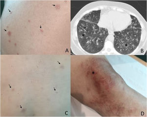 A) Granulomas en la espalda en el momento del diagnóstico (flecha). B) TAC-AR de tórax con afectación intersticial bilateral (asterisco) y engrosamiento reticular (flecha). C) Mejoría de los granulomas tras dos meses de tratamiento (flecha). D) Pápulas de la rodilla donde se obtuvo la muestra de la biopsia (asterisco). TAC-AR: tomografía axial computarizada de alta resolución.