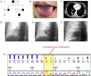 The genetic and clinical characteristics of the family with HHT. (A) Pedigree of the HHT family. The proband is indicated by an arrow. I, II, III: first, second, and third generation, respectively. (B) The proband (II-3) exhibited multiple red spots on the tongue (black arrow). (C) Chest contrast-enhanced CT scan showed arteriovenous malformations of the lungs. (D, E) Pulmonary angiography revealed multiple PAVM located in the inferior lobe area of the right lung. (F) Chest fluoroscopy after PAVM closure. (G) Sanger sequencing showed the patient had a heterozygous c.392delC (chr9:130588920) mutation. The red arrow shows the feeding artery and the blue arrow shows the draining vein; CT, computed tomography.