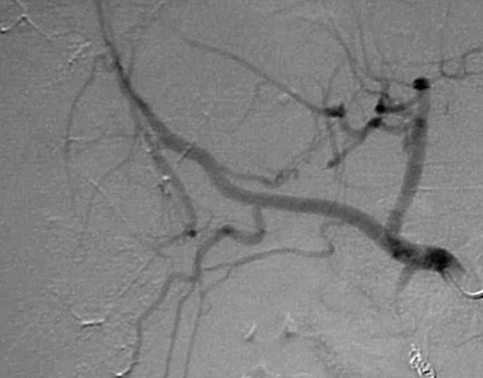 Reservorio intraarterial hepático para quimioterapia. Colocación ...