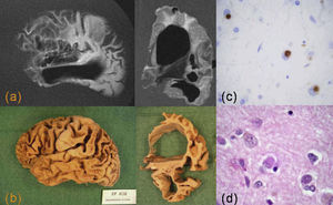 Enfermedad de Pick. a) Resonancia magnética con corte sagital potenciado en T1 y corte coronal FLAIR. b) Hemisferio cerebral, visión lateral y corte coronal. Hay una importante atrofia de la corteza frontal y temporal anterior con alteración de señal en la sustancia blanca frontal. Imágenes microscópicas de la corteza cingular con tinción HE (c) y tau (d), en las que se observan células balonizadas y cuerpos de Pick intraneuronales tau (+).
