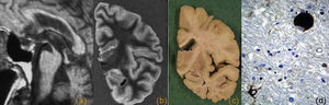 Parálisis supranuclear progresiva. a) Resonancia magnética (RM) premortem, corte sagital potenciado en T1 donde se observa una atrofia selectiva del mesencéfalo (signo del colibrí). RM posmortem, corte coronal FLAIR (b) y corte coronal macroscópico (c) que muestran un cerebro normal. Imagen microscópica teñida con tau donde se observa un ovillo neurofibrilar de forma globosa y un astrocito con aspecto en penacho (d).