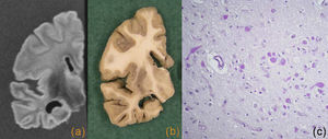 Lipofuscinosis ceroide. Cortes coronales de resonancia magnética (a) y macroscópicos (b) con una importante atrofia global y alteración de señal de la sustancia blanca. c) Imagen microscópica con tinción PAS, donde se observan acúmulos de lipofuscina en corteza.