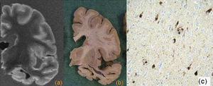 Enfermedad de Alzheimer. Cortes coronales de resonancia magnética (a) y pieza macroscópica (b), donde se observa una importante atrofia del hipocampo y de la corteza entorrinal. c) Imagen microscópica del hipocampo, con tinción tau, donde se observa la presencia de múltiples ovillos neurofibrilares intraneuronales y placas neuríticas aisladas.