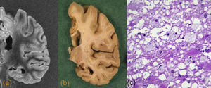 Demencia vascular. Cortes coronales de resonancia magnética (a) y macroscópico (b), donde se observa un infarto crónico de la arteria cerebral anterior, con afectación de la corteza pericallosa. En la resonancia magnética se observa una hiperintensidad en la sustancias blanca y gris, y atrofia secundaria. c) En la imagen microscópica se observa una zona de necrosis, con presencia de macrófagos espumosos y astrocitos reactivos (tinción HE).