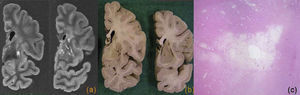 Demencia vascular. Cortes coronales de resonancia magnética (a) y macroscópico (b) de un paciente con demencia y múltiples infartos lacunares en ganglios basales y sustancia blanca subcortical. c) En la imagen microscópica a bajo aumento se observa un infarto lacunar en putamen (tinción HE).