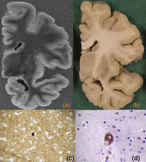 Demencia de cuerpos de Lewy. Cortes coronales de resonancia magnética (a) y macroscópico (b) donde no hay atrofia significativa. Imagen microscópica donde se observa un cuerpo de Lewy cortical (tinción anti-α-sinucleína) (c) y un cuerpo de Lewy en una neurona de la sustancia negra (tinción HE) (d).