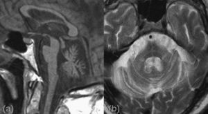 Atrofia multisistema. Resonancia magnética premortem. a) Corte sagital potenciado en T1 en el que se observa una importante atrofia de la protuberancia con aplanamiento inferior. b) Corte axial potenciado en T2 donde además de la atrofia pontina se observa una alteración de señal en forma de cruz. También se demuestra una atrofia, con hiperintensidad de señal, en los pedúnculos cerebelosos medios.