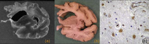 Degeneración lobular frontotemporal TDP-43 (+). Corte coronal de resonancia magnética (a) y pieza macroscópica (b) con una importante atrofia cortical frontal y una alteración de señal en la sustancia blanca. c) Imagen microscópica con técnica de inmunohistoquímica anti TDP-43 que muestra una inclusión intranuclear.