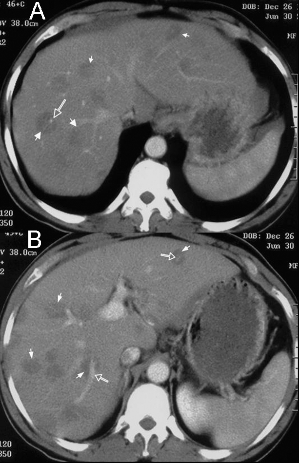 Soluci n Del Caso 5 Esteatosis Hep tica Focal Multinodular Radiolog a soluci-n-del-caso-5-esteatosis-hep-tica-focal-multinodular-radiolog-a
