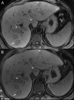 soluci-n-del-caso-5-esteatosis-hep-tica-focal-multinodular-radiolog-a