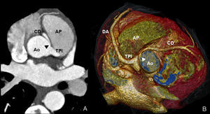 Varón de 21 años, con dolor torácico atípico. Se le realizó coronariografía mediante tomografía computarizada de doble fuente (TCDF) por posible anomalía coronaria por ecocardiografía. A) Imagen axial. B) Reconstrucción volumétrica. El estudio puso de manifiesto un origen anómalo de la arteria coronaria derecha (CD) (punta de flecha) por encima del seno contralateral, con un trayecto interarterial anómalo entre la aorta (Ao) y la arteria pulmonar (AP). DA: descendente anterior; TPI: tronco principal izquierdo.