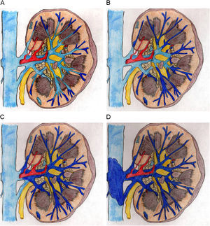 Fisiopatología de la trombosis venosa renal neonatal; a diferencia de las trombosis asociadas al uso de catéteres, la trombosis venosa renal comienza en las venas intrarrenales de pequeño calibre (A). El trombo puede diseminarse a la corteza o a la médula, o más frecuentemente a través de las venas interlobares de mayor calibre (B) hasta la vena renal principal (C) y vena cava inferior (D).
